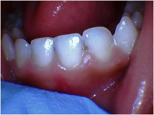 Oral tissue and causes 1