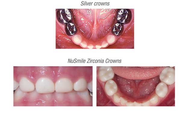 silver crown teeth